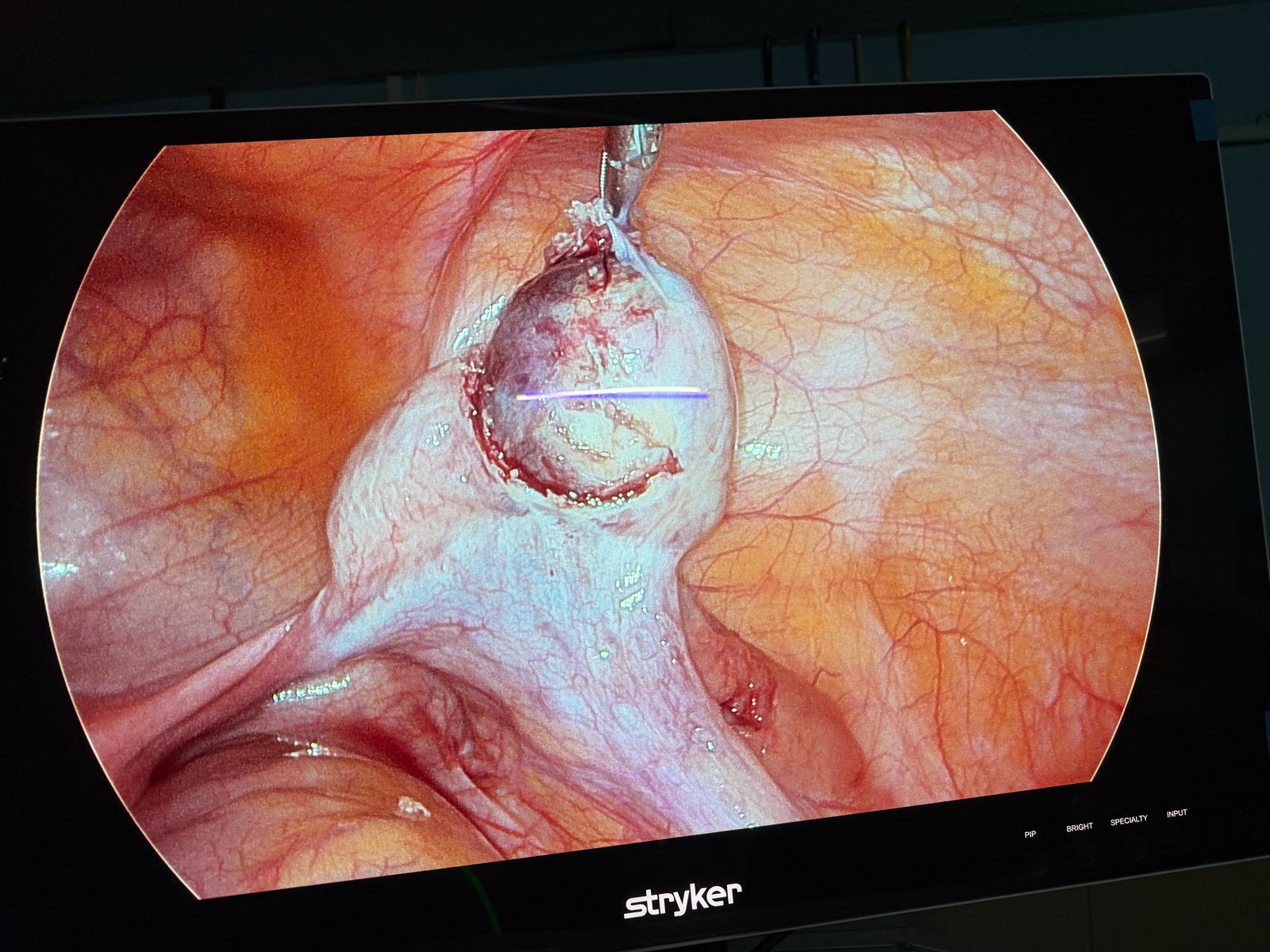 Dr. Mariam Anjum — Dermoid Excision — Surgical Atlas
